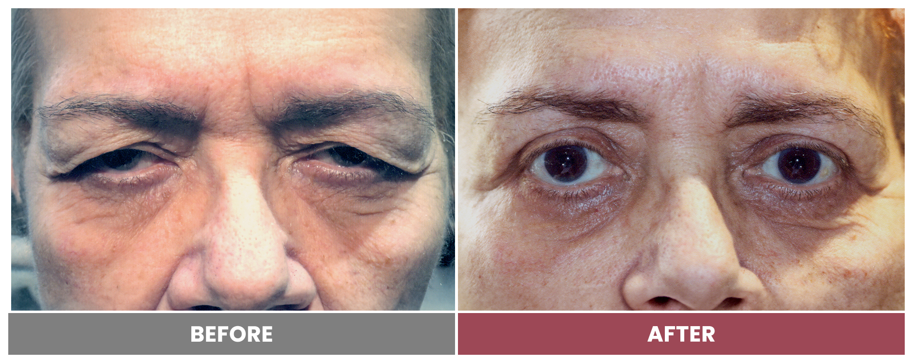 Upper Blepharoplasty - Case 99